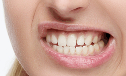 علت واقعی دندان قروچه شما